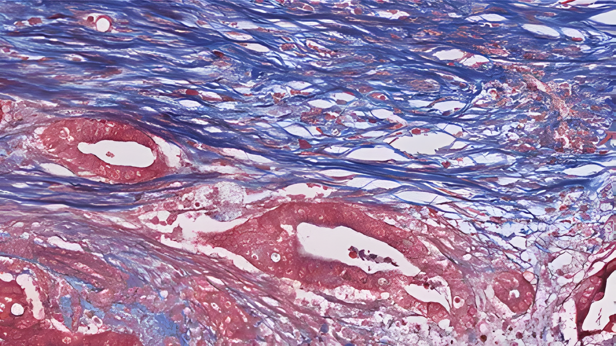 Pancreatic cancer cell atlas highlights why many promising treatments fail