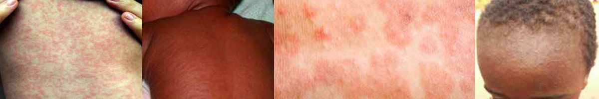 header-measles