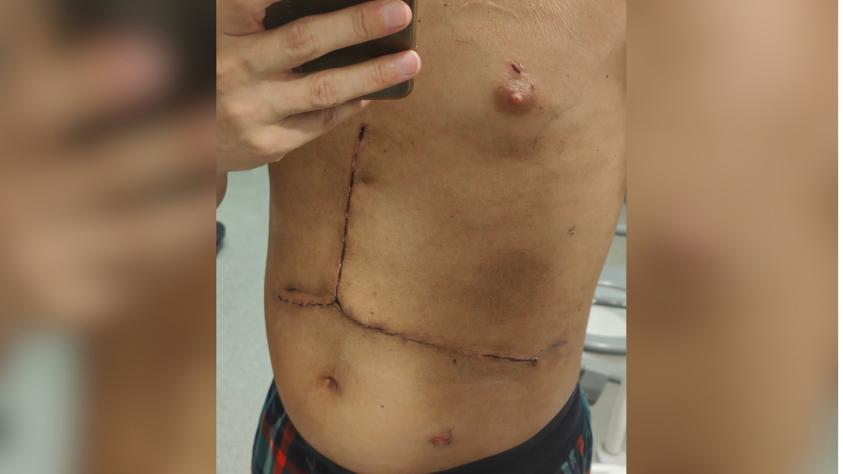 Chris following his liver transplant